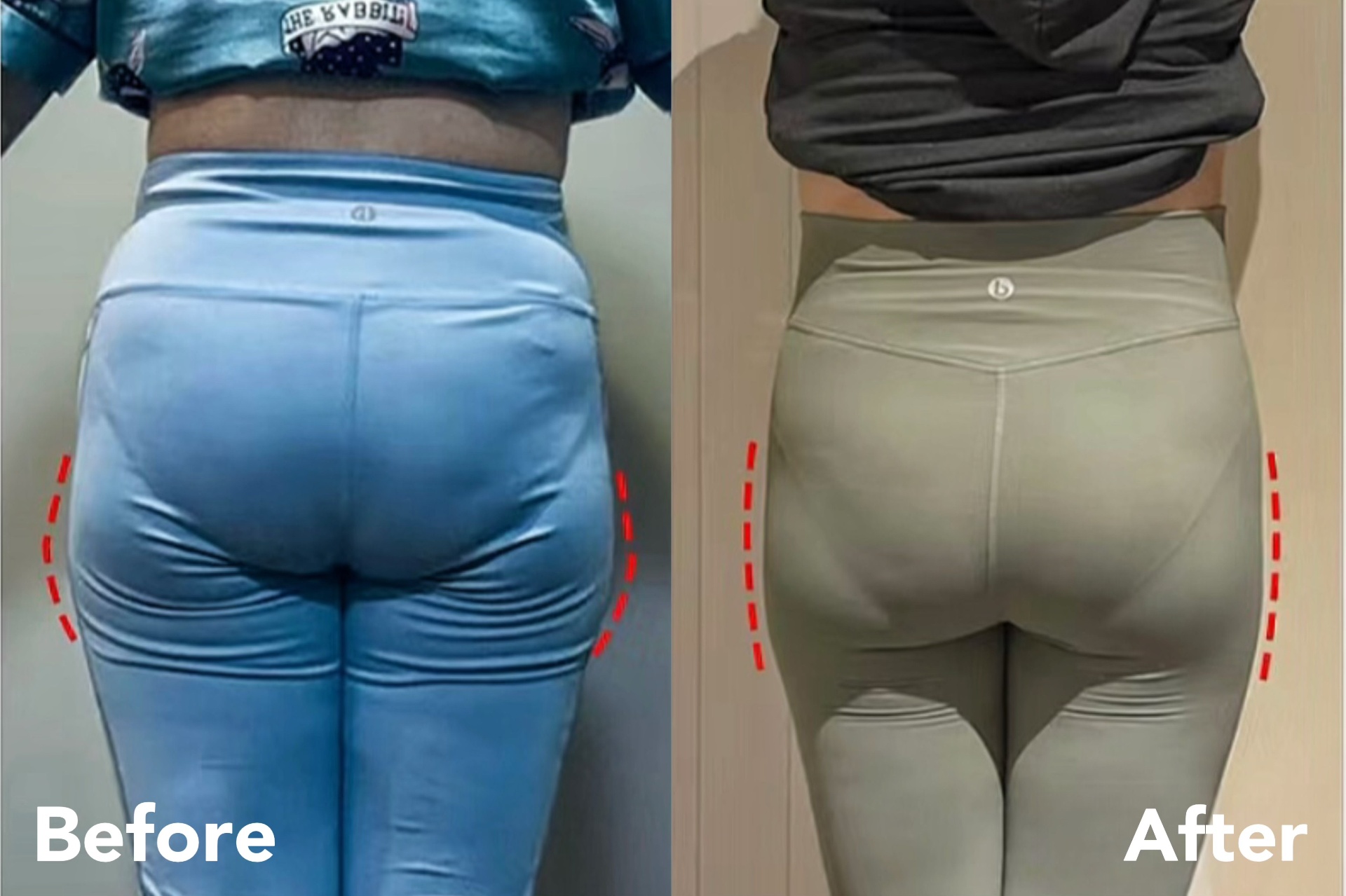 Hip Dip Improvement — before and after transformation