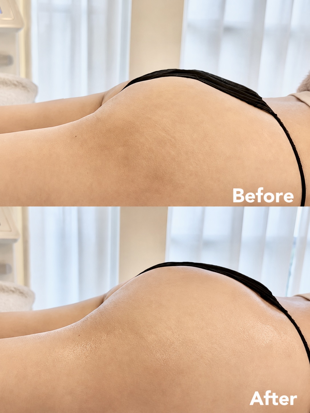 Lift Buttocks before and after — enhanced glute projection and contour