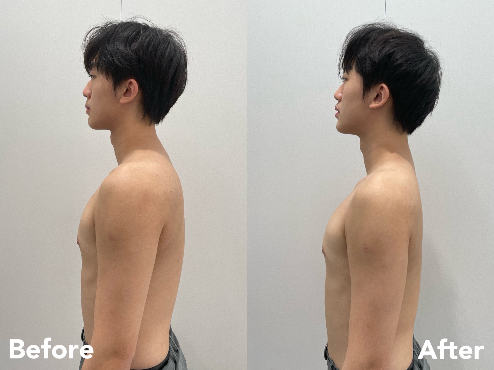 Male posture correction before and after — shoulder and upper body posture
