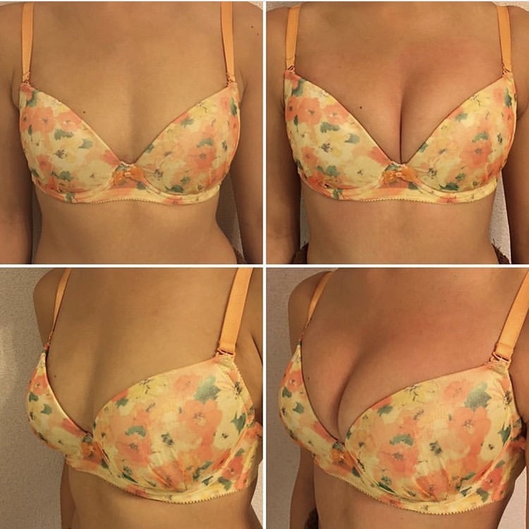 Natural shape enhancement — case 1 before and after