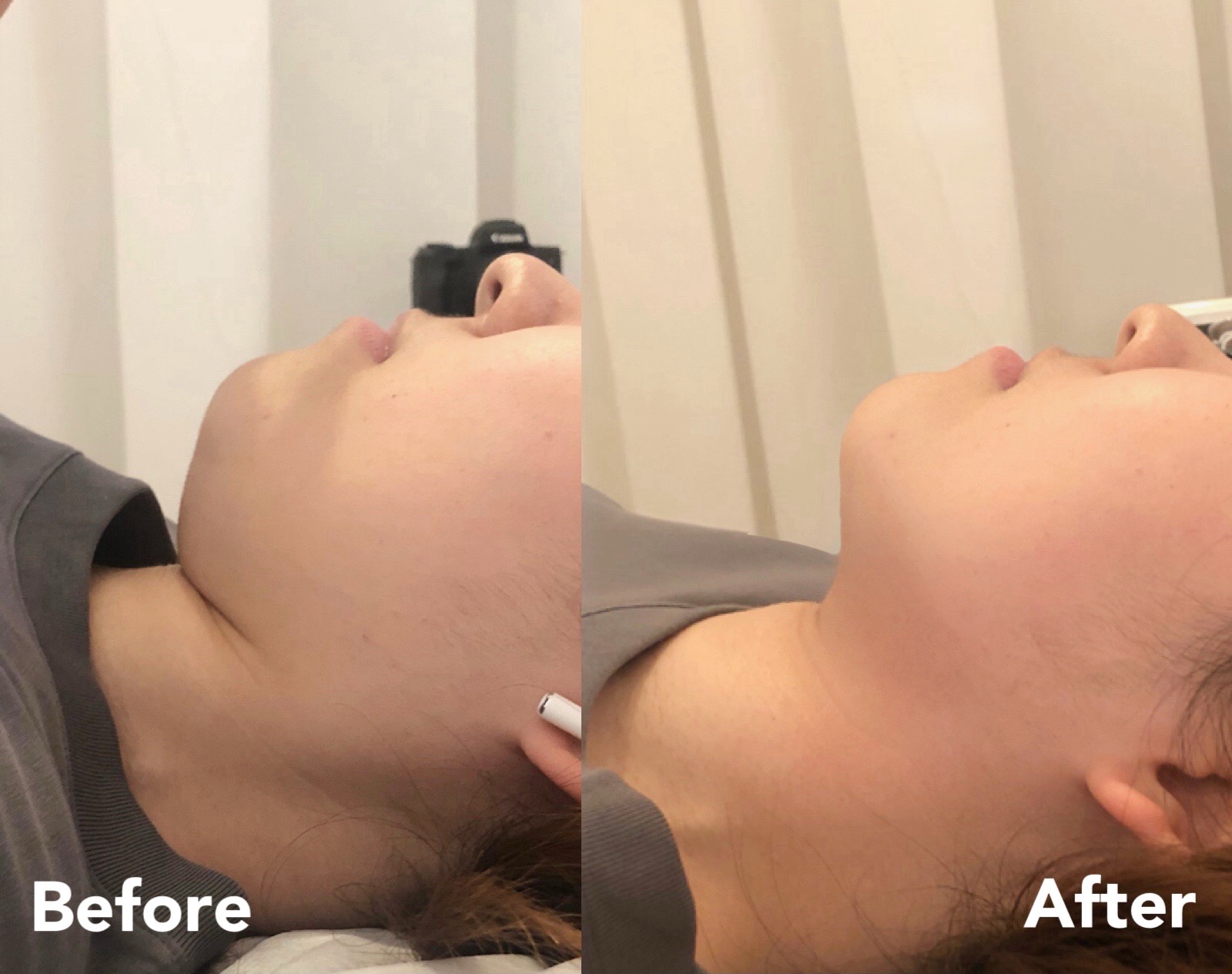 Jawline and double chin — before and after, case 2
