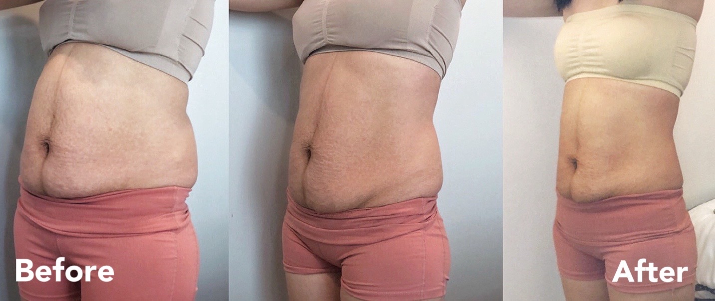 Postpartum belly recovery — front view before and after
