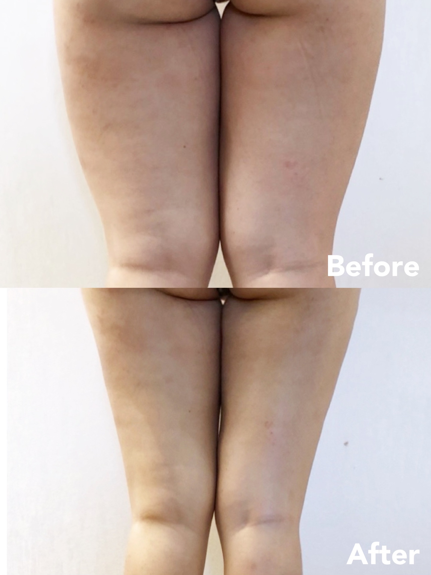 Slim Thighs before and after — inner and outer thigh refinement
