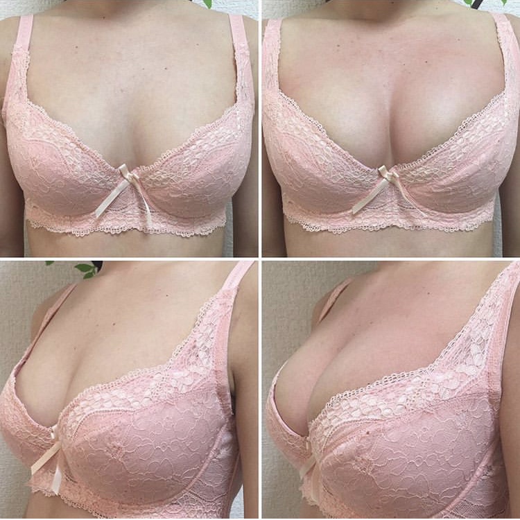 Natural shape enhancement — case 2 before and after
