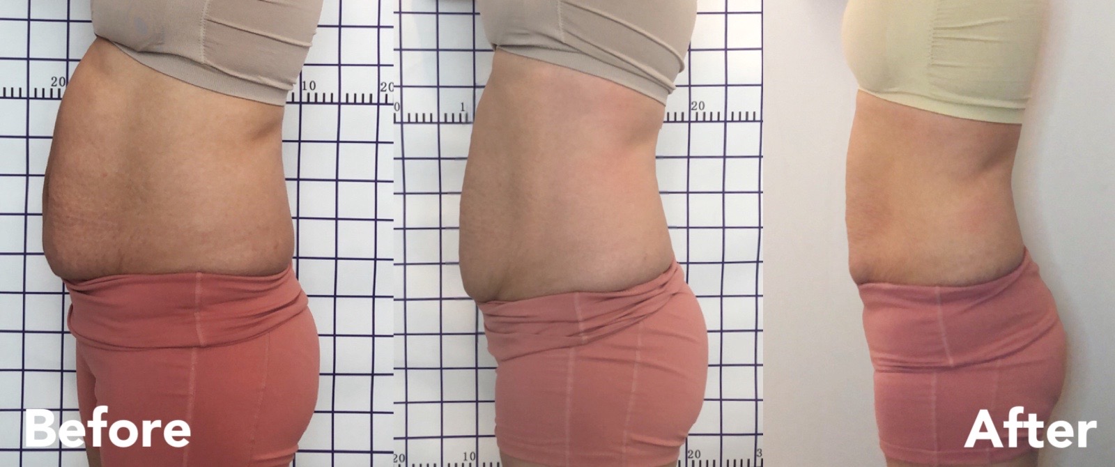 Postpartum belly recovery — side progress before, mid and after