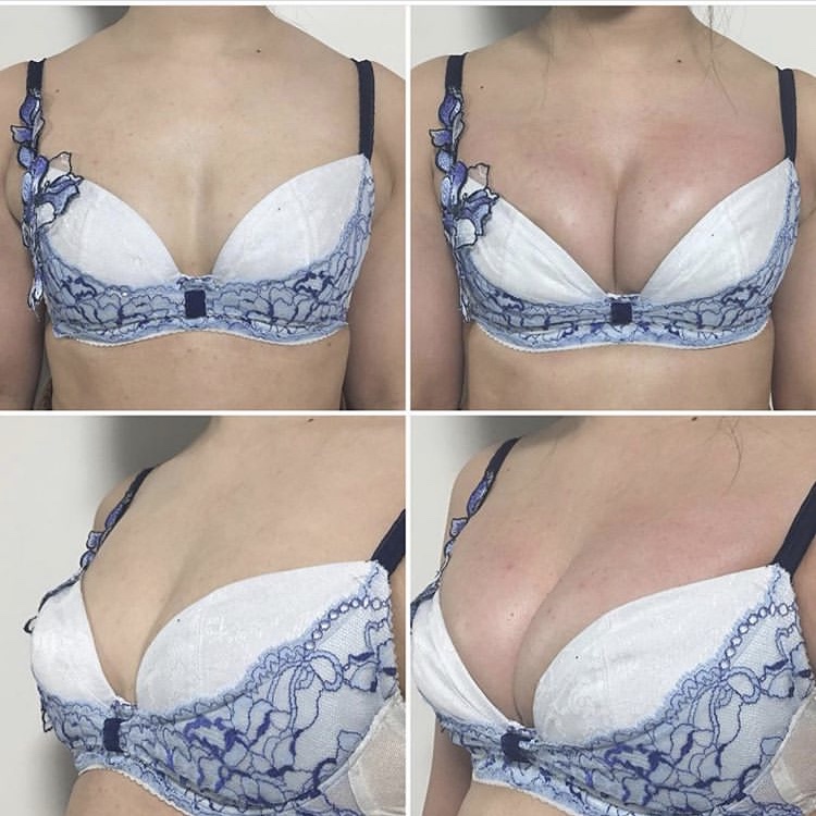 Upper pole fullness — case 2 before and after