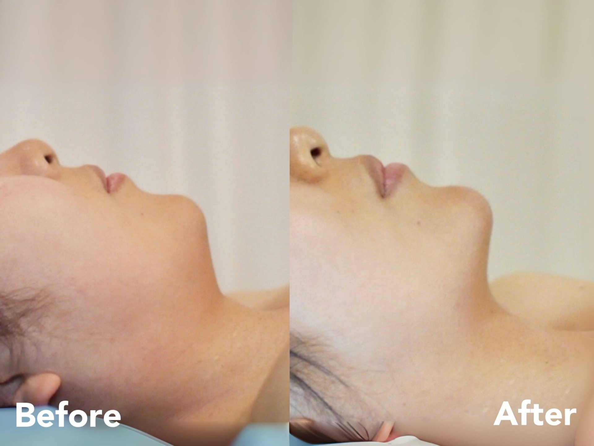 Jawline and double chin — before and after, case 1