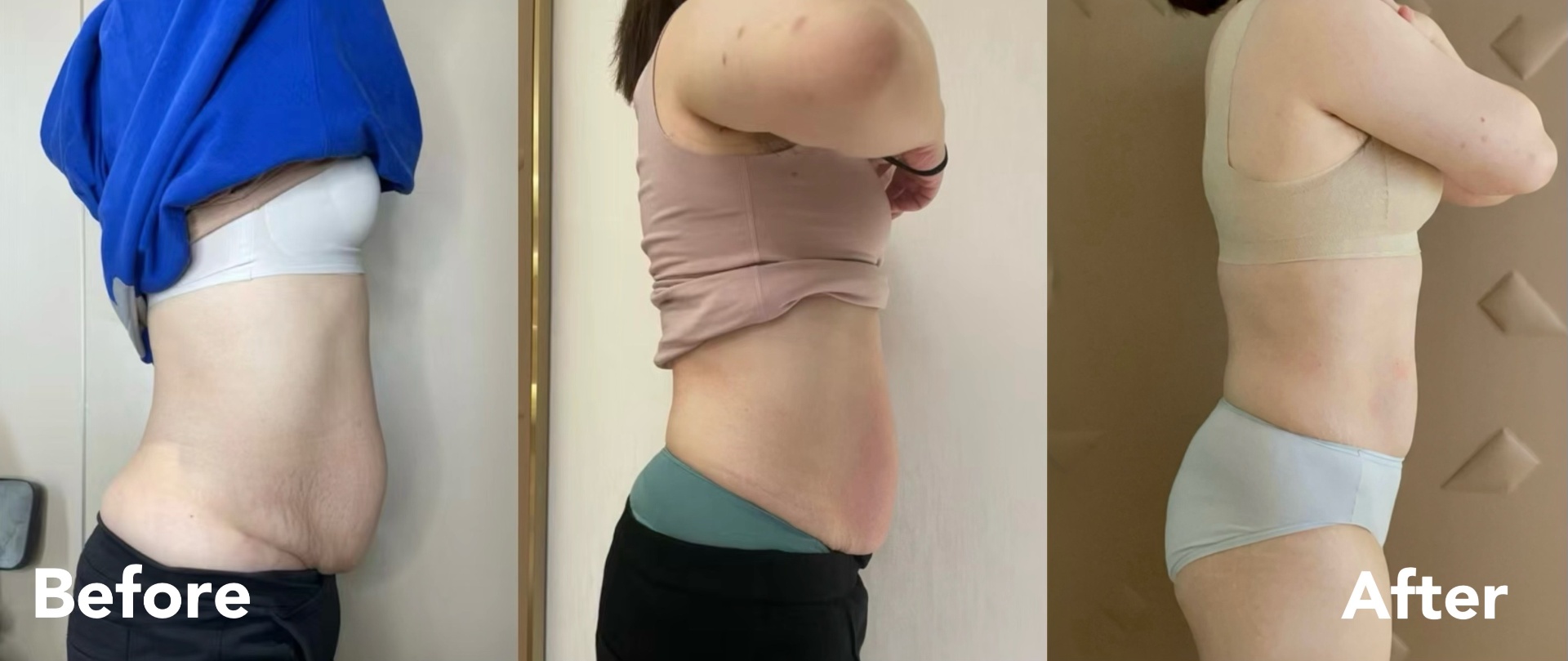 Postpartum belly recovery — side view before and after