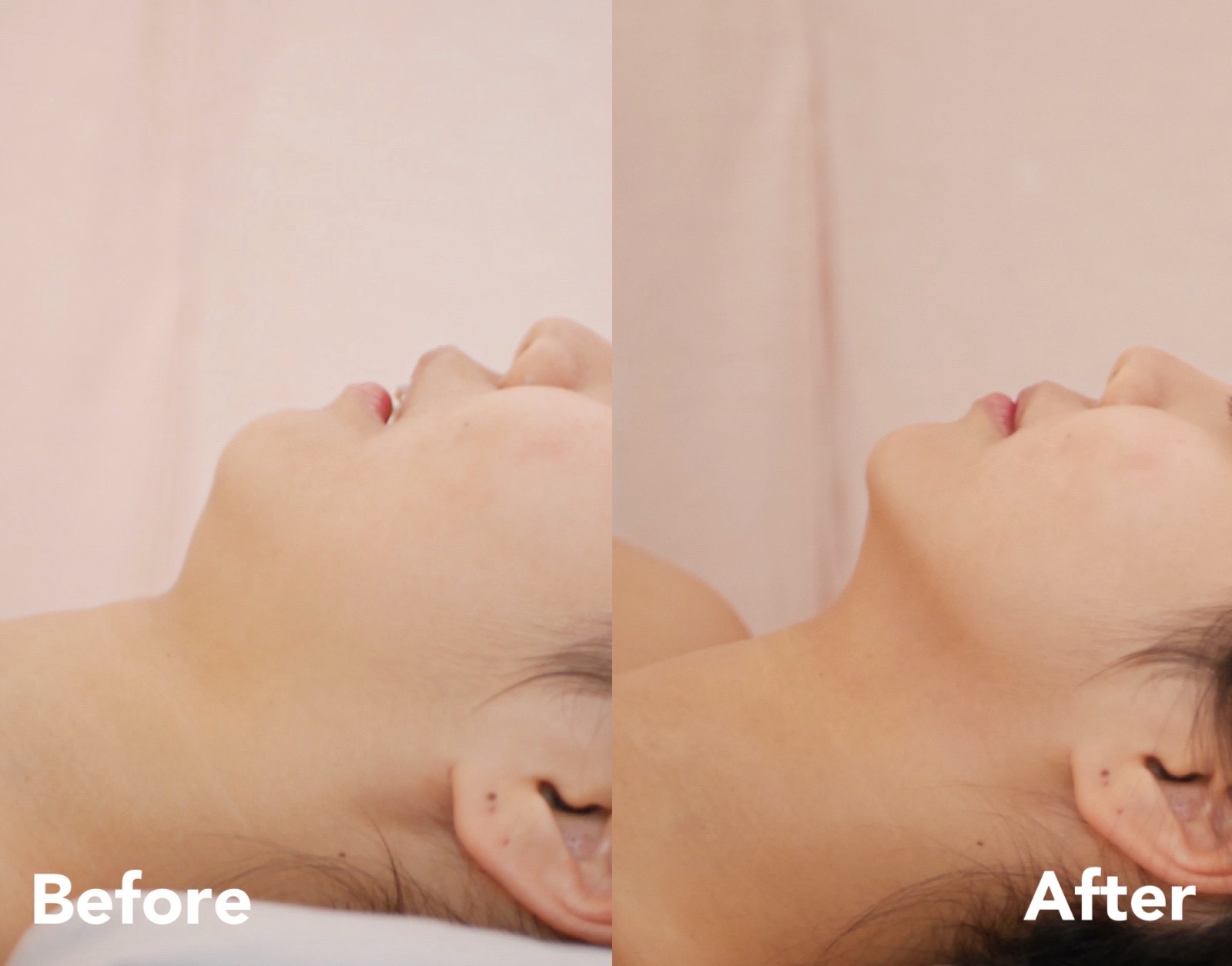 Jawline and double chin — before and after, case 3