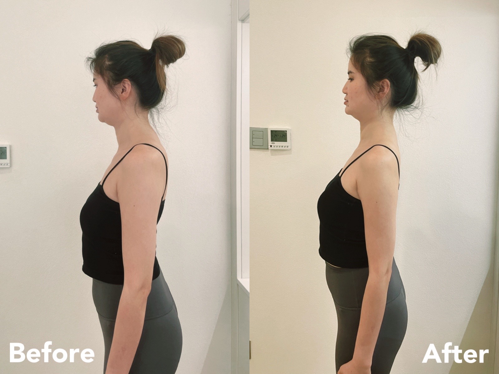 Female posture correction before and after — forward head and neck alignment