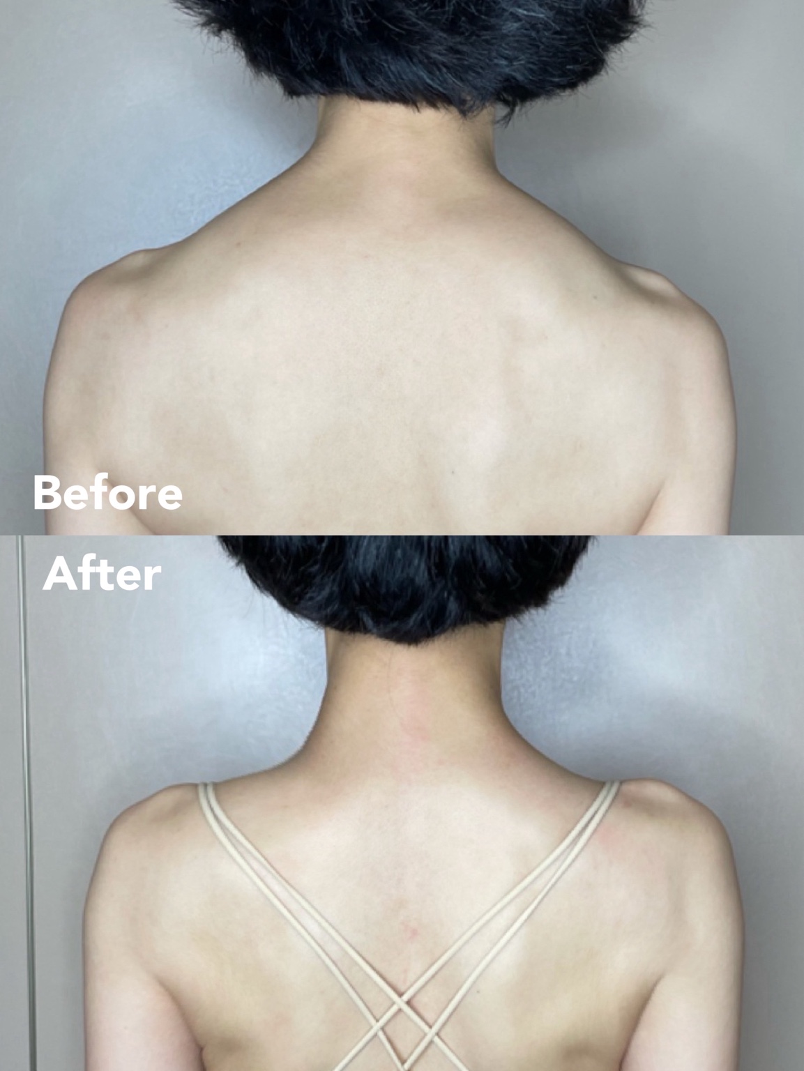 Slim Trapezius before and after — shoulder and neck line refinement