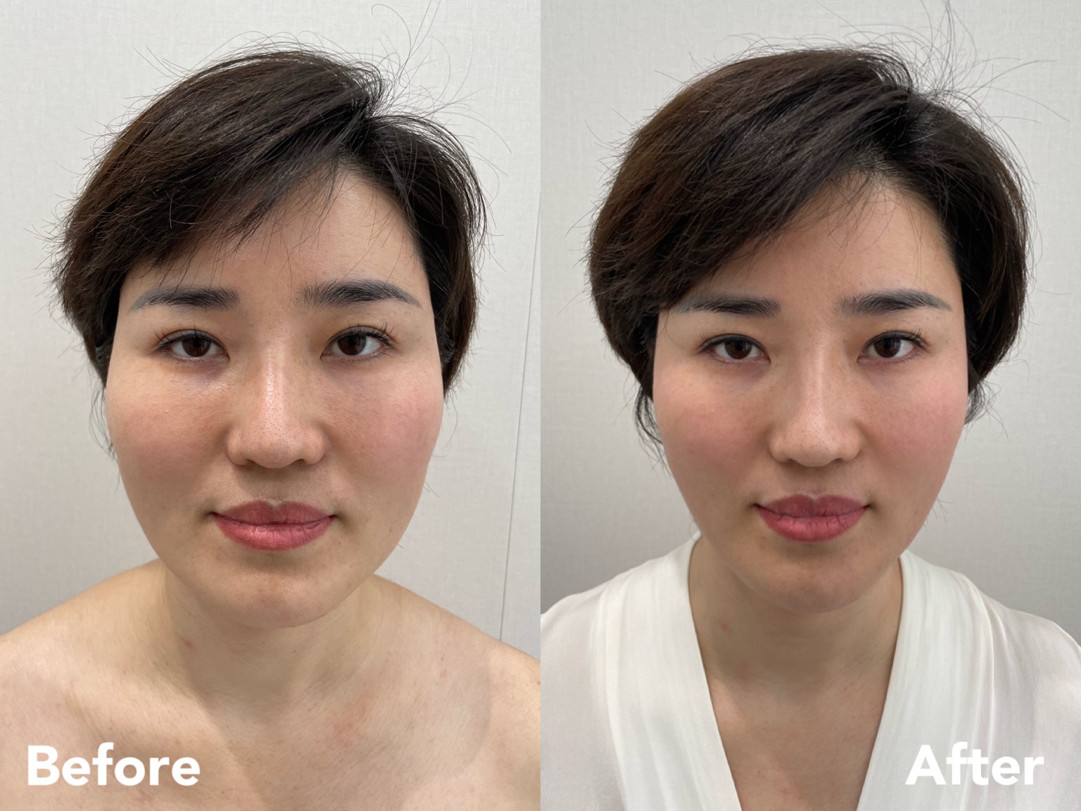 Facial balance and symmetry — before and after