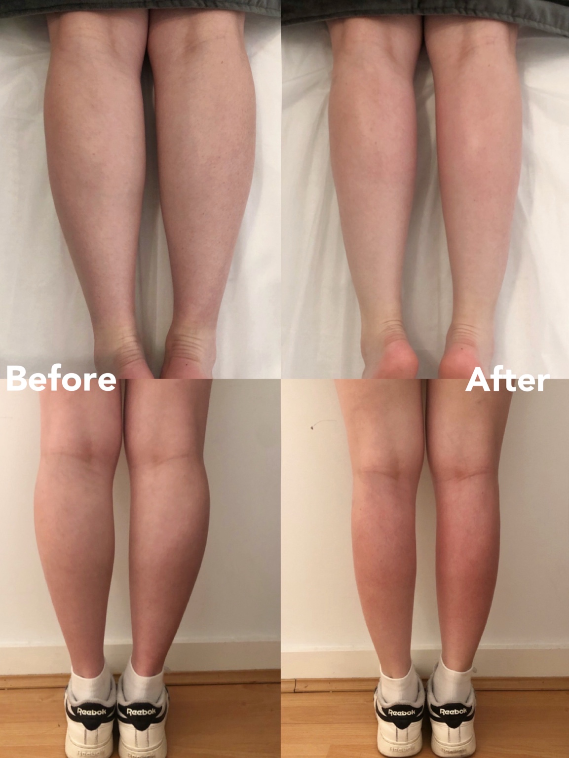 Slim Calves before and after — lower-leg contour refinement
